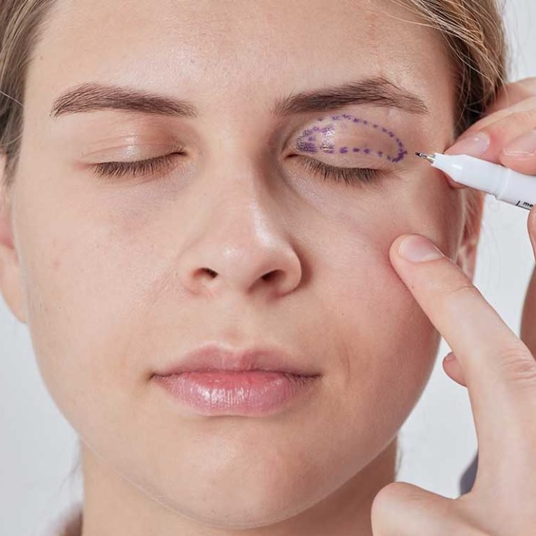 Blepharoplasty