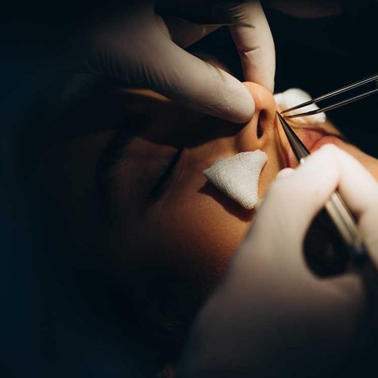 rhinoplasty
